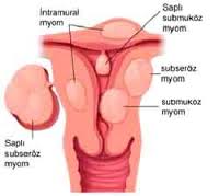 tumor rahim