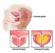 obat tradisional tumor prostat